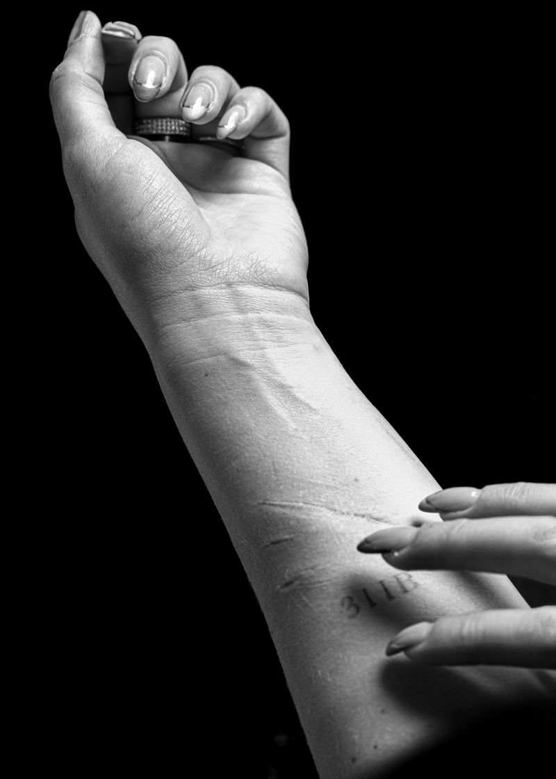 © Niccolò Zorza - Image from the Scars - Behind every scar there is a story photography project