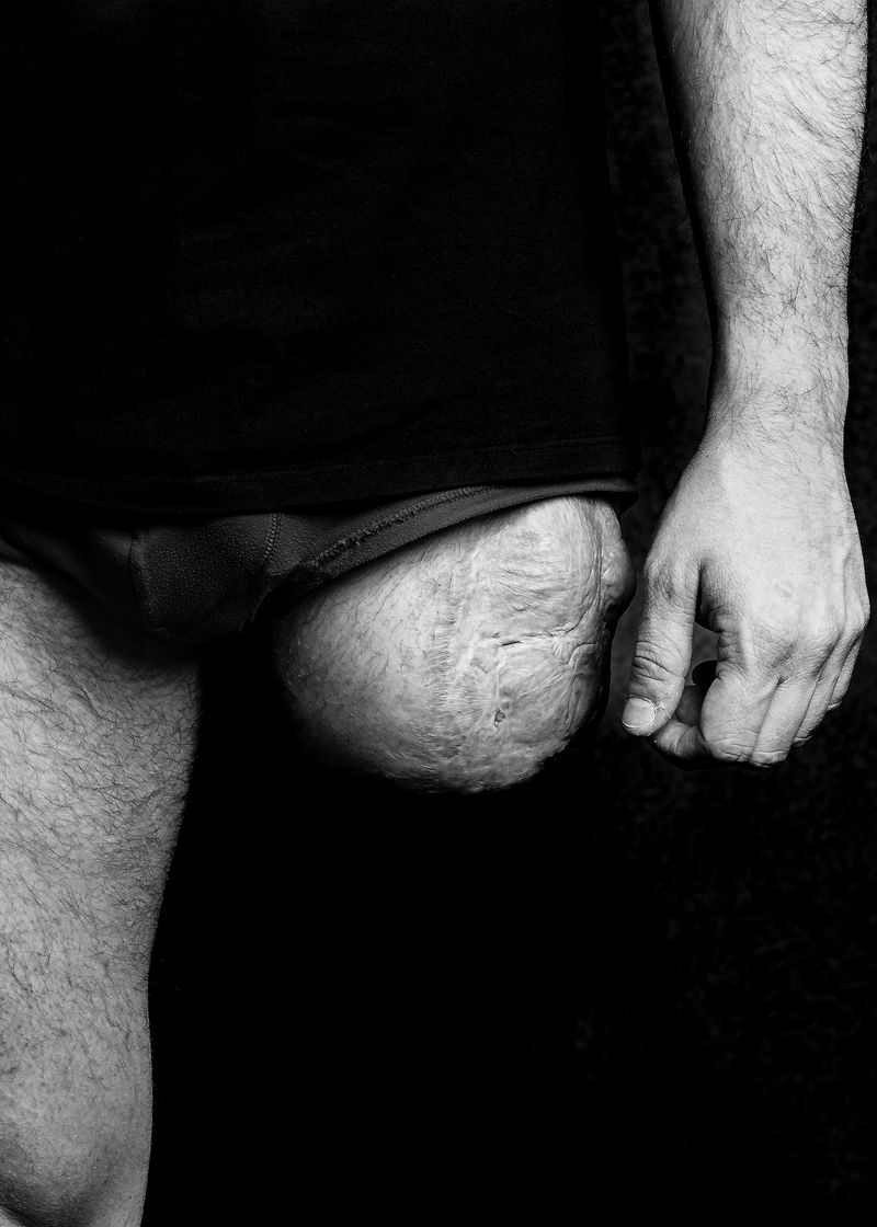 © Niccolò Zorza - Image from the Scars - Behind every scar there is a story photography project