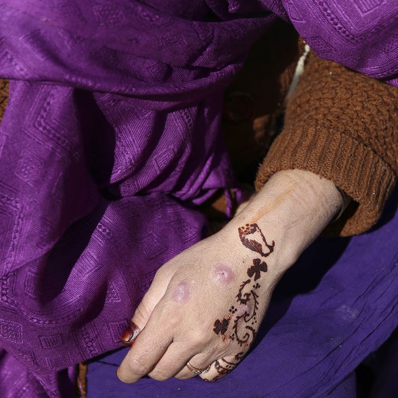 © Johanna Maria Fritz - Miriam is in the detox clinic again. On her hand you can see stab wounds from the drug abuse.