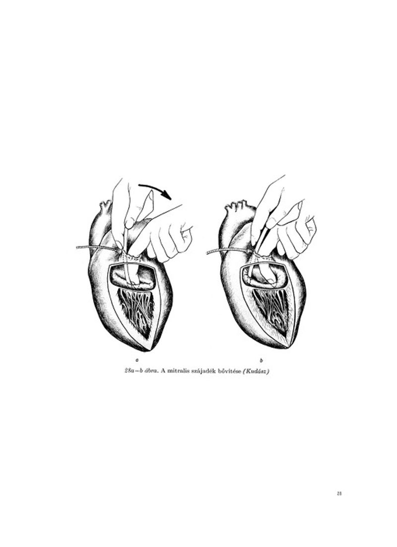 © Gábor Arion Kudász - The surgical widening of the heart valve invented by my grandfather as described in his book.