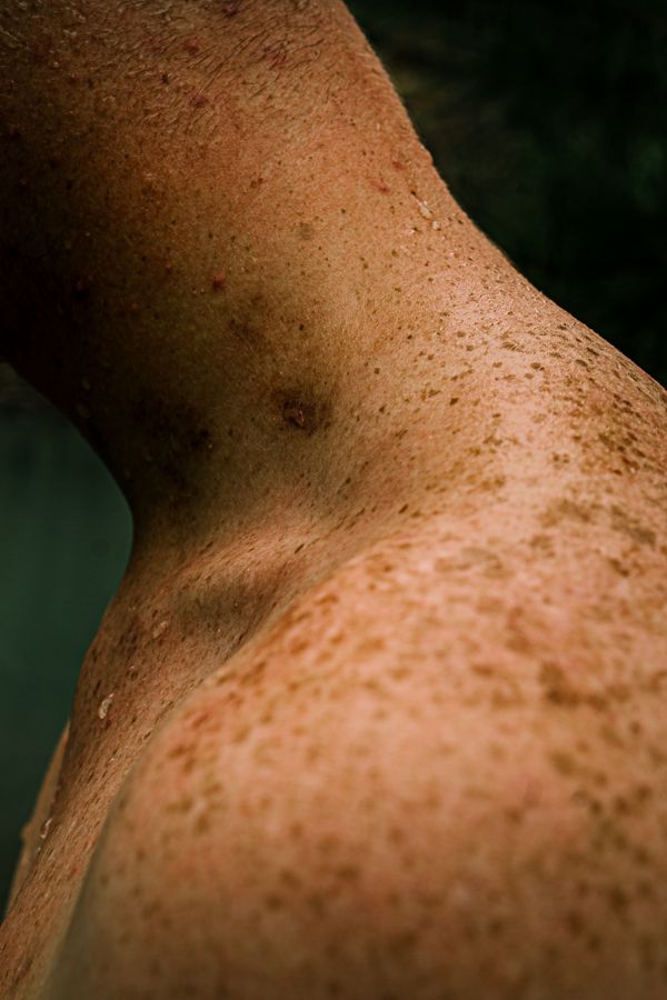 © Tajette O'halloran - A man's neck with a love bite