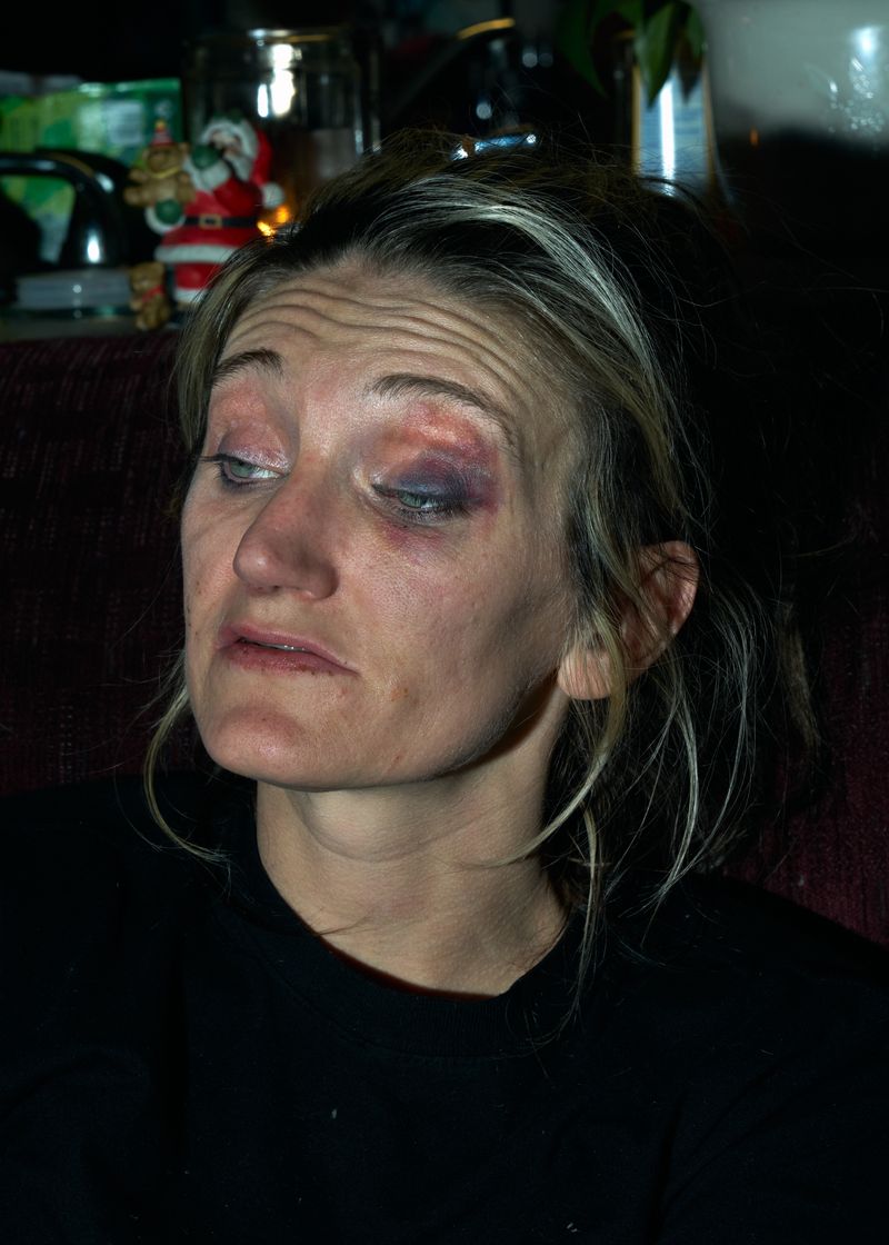 © Stacy Kranitz - After Mayron relapsed, she came home with a black eye. She does not know how she got it.
