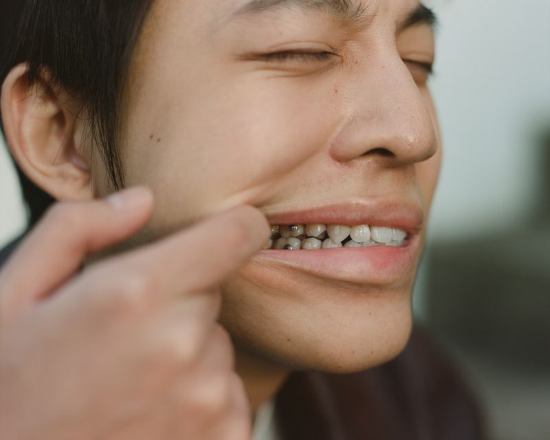 © Yongjie Hu - This is the pin left in his teeth following his facial surgery. He told me only those close enough could see it.
