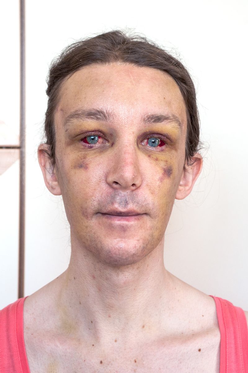 © Giulia Thinnes - Me after facial feminization surgery