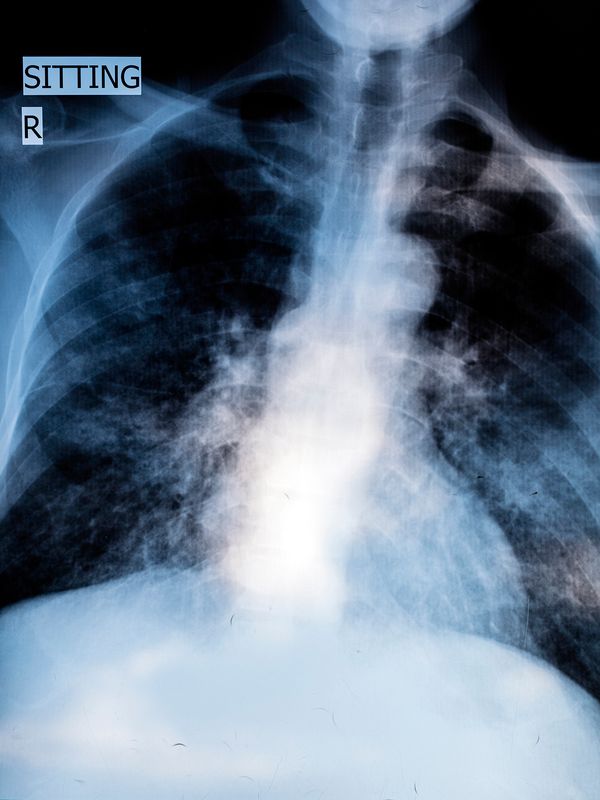 © Ilan Godfrey - An X-ray revealing the extent of Mncedisi Kidman Nkotha’s tuberculosis, Wonderkop, Western Limb