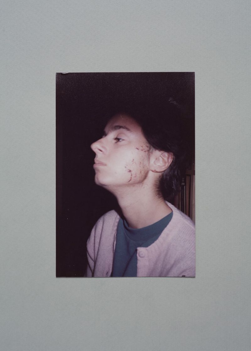 © Martino Lombezzi - Napoli, July 2014. A photograph portraying Cinzia D'Esposito wounded in her face days after the explosion.