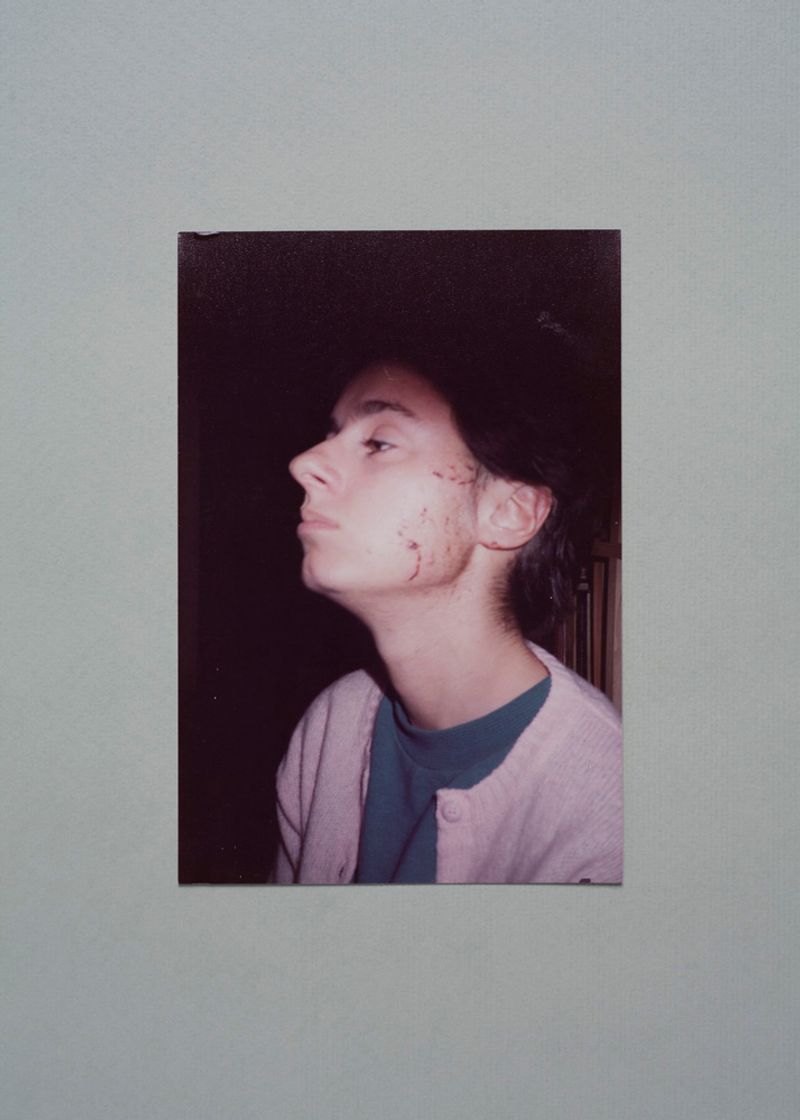 © Martino Lombezzi - Napoli, July 2014. A photograph portraying Cinzia D'Esposito wounded in her face days after the explosion.