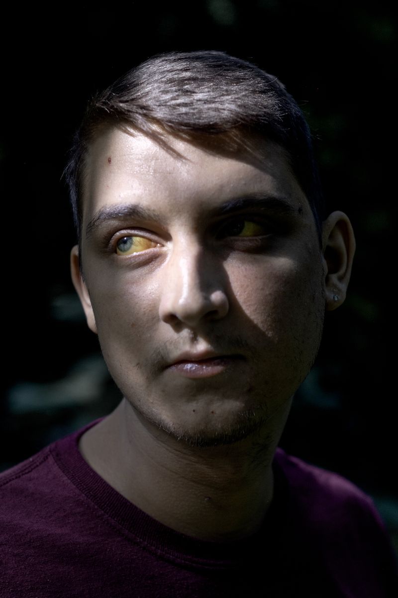 © Jordan Gale - Portrait of Logan with jaundice, six months before his death.