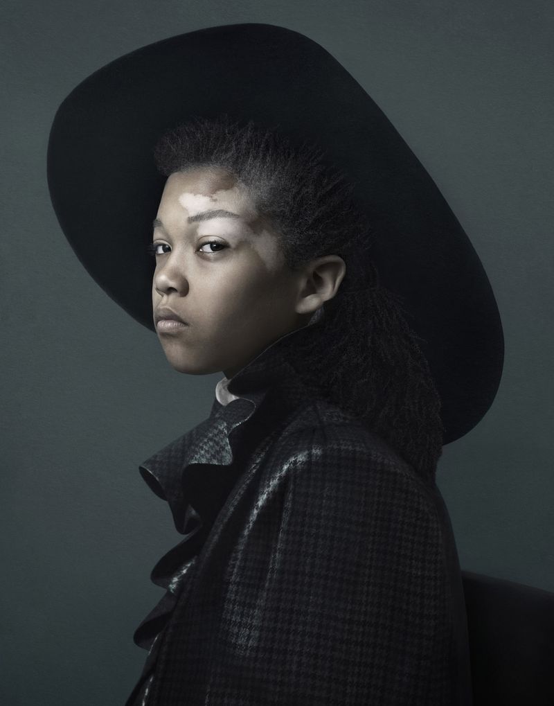© Justine Tjallinks - Doriano - Vitiligo