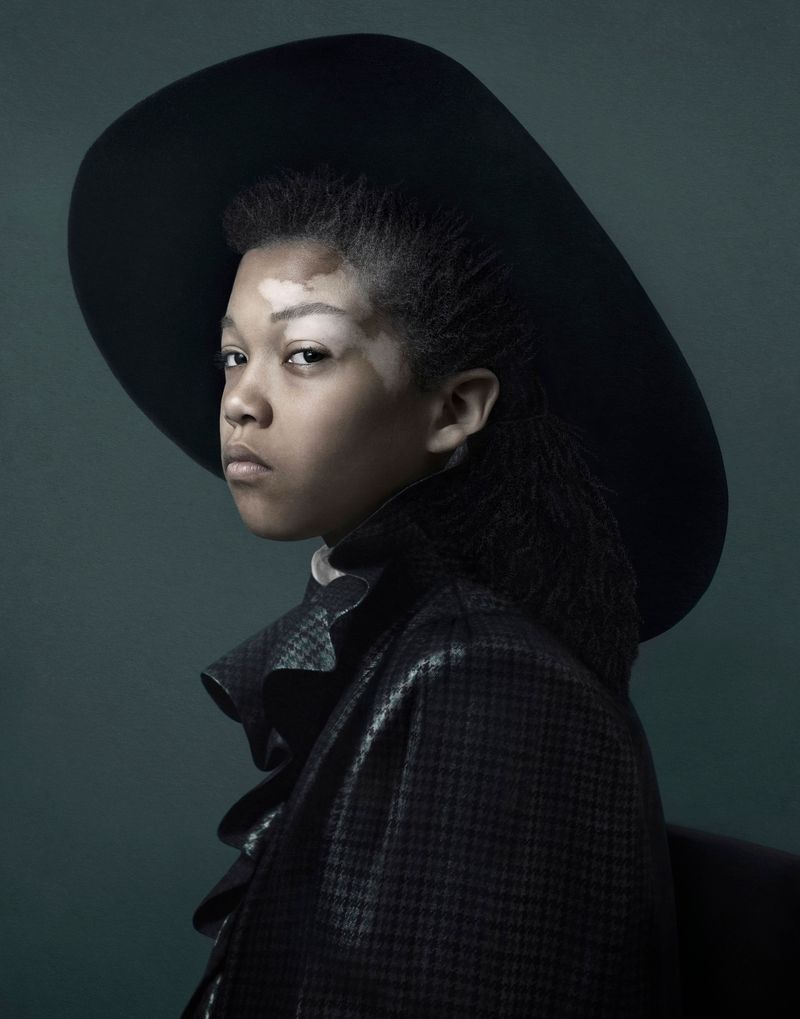 © Justine Tjallinks - Doriano - Vitiligo