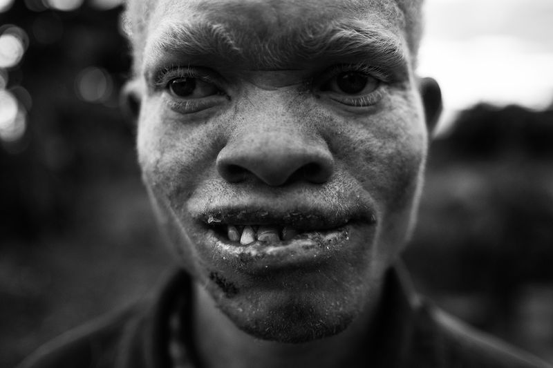 © Daniel Rodrigues - Image from the The hunted - albinos photography project