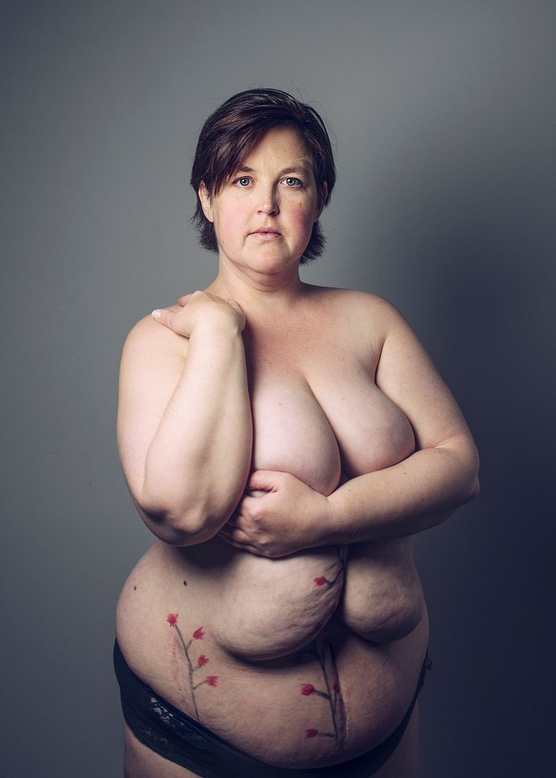 © Gery ten Broek - SUZANNE Suzanne was born with congenital nephrotic syndrome. On her second year both kidneys were removed