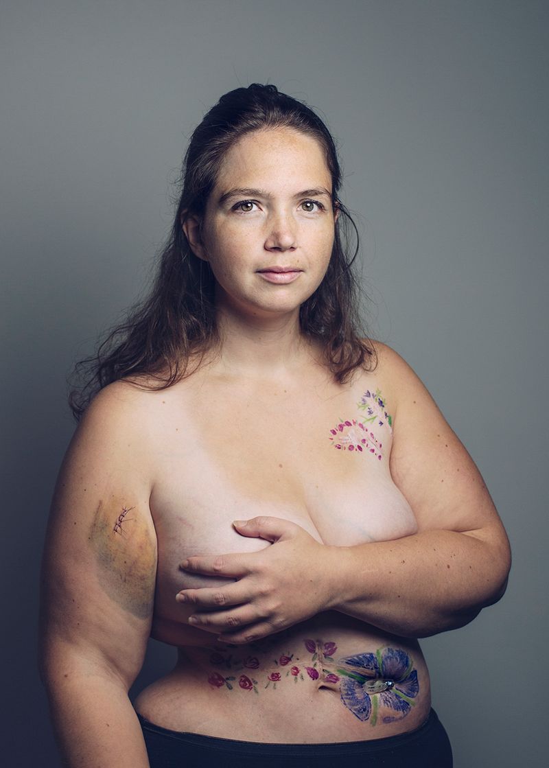 © Gery ten Broek - LIESBETH Liesbeth's kidney and tumor have been removed