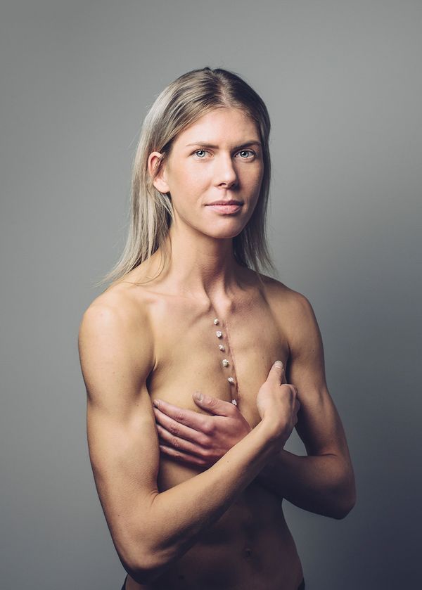 © Gery ten Broek - SYLVIA Sylvia has had open heart surgery twice as a baby and once at the age of 15