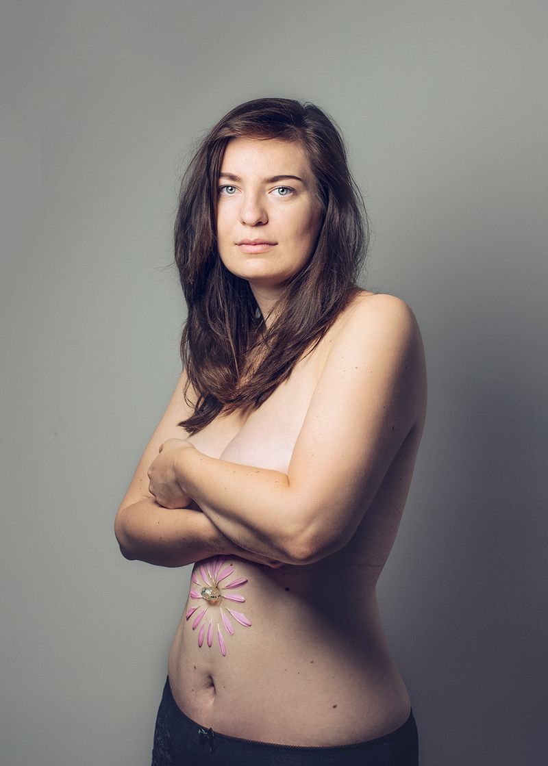 © Gery ten Broek - ANOUK Anouk received a PEG probe because her stomach and intestines no longer functioned so she could no longer eat or drink