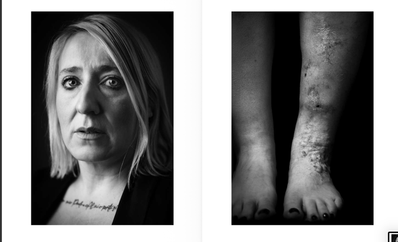 © Niccolò Zorza - Image from the Cicatrici (Scars) Dietro ogni cicatrice c'è un racconto. Behind every scars there is a story. photography project