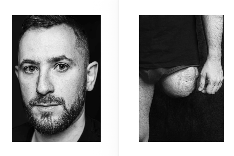 © Niccolò Zorza - Image from the Cicatrici (Scars) Dietro ogni cicatrice c'è un racconto. Behind every scars there is a story. photography project