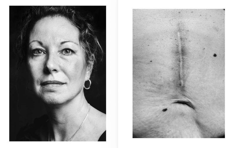 © Niccolò Zorza - Image from the Cicatrici (Scars) Dietro ogni cicatrice c'è un racconto. Behind every scars there is a story. photography project