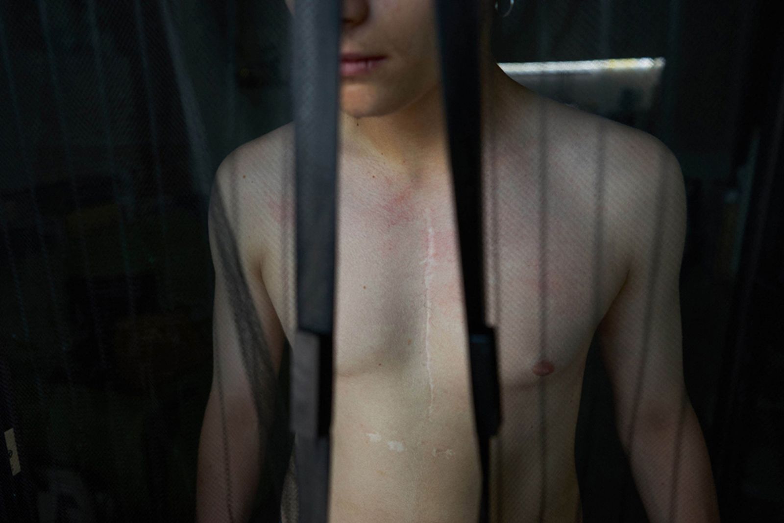 © Danilo Garcia Di Meo - A scar on Enrico's chest who had an open heart operation as a child