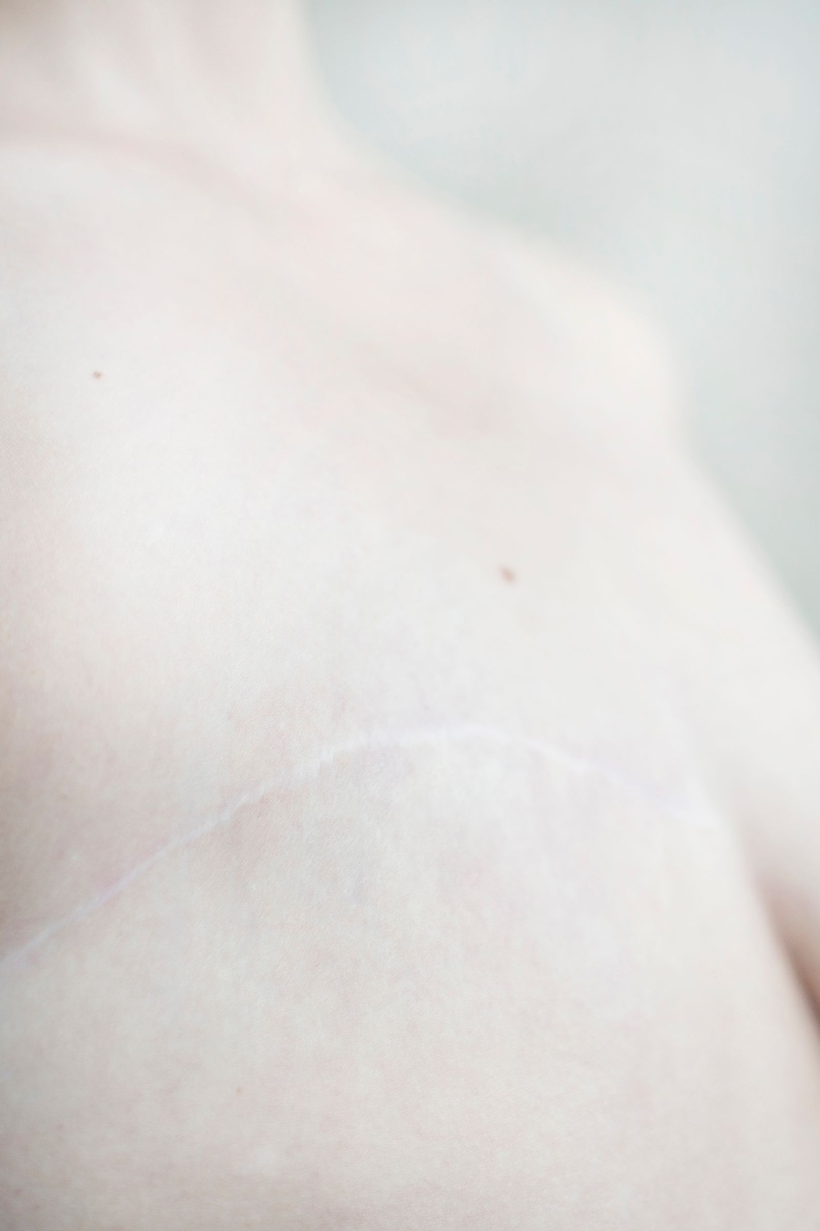 © Sergei Stroitelev - Scar left after mastectomy.