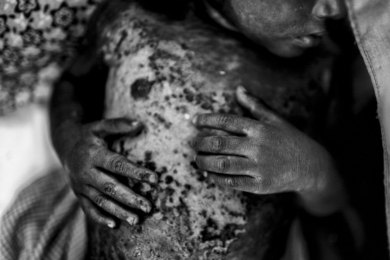 © Mohammad Rakibul Hasan - Hares is a one year old boy, his family suddenly found their house is burring that was set by the Myanmar Army.