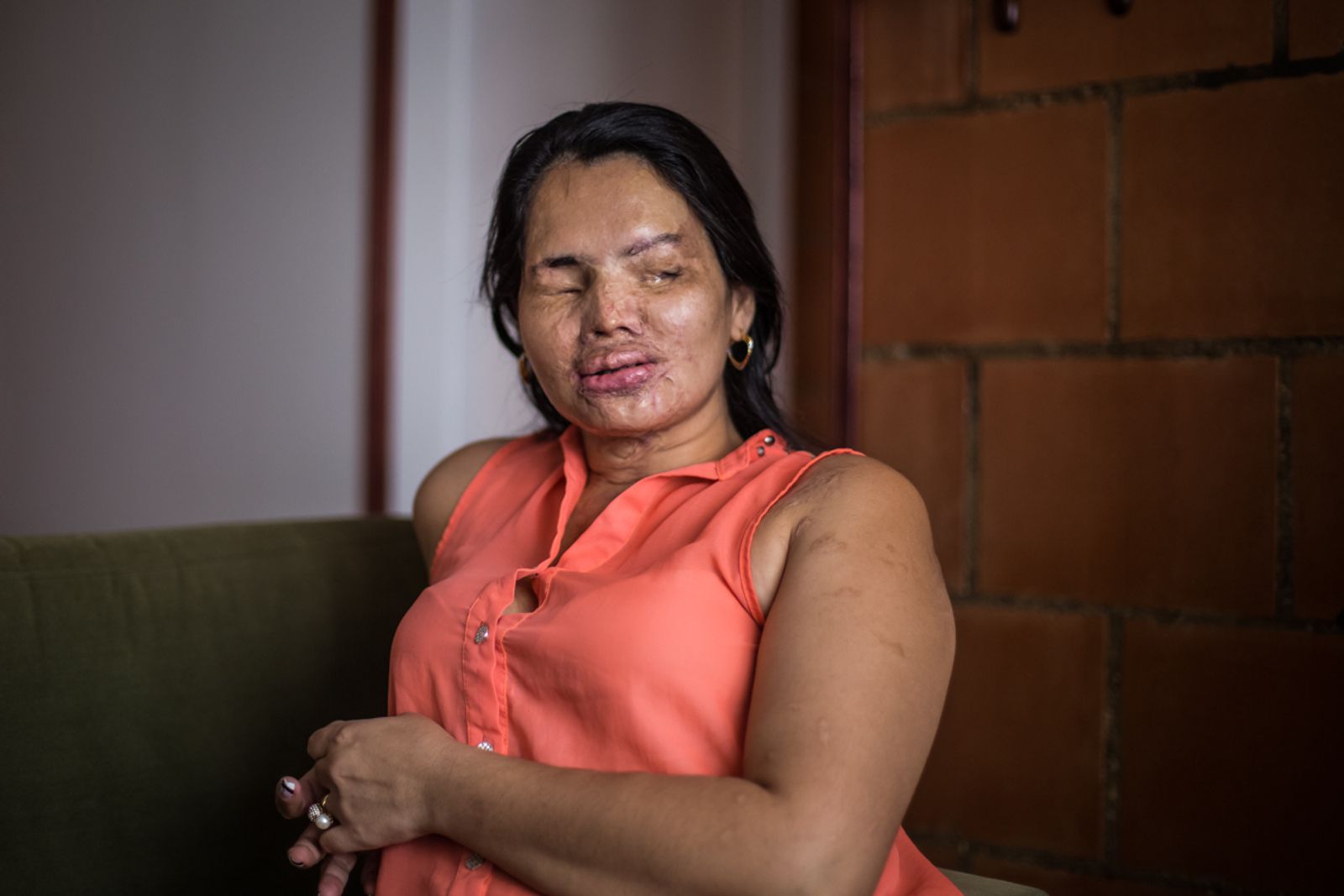 © Betty Laura Zapata - Image from the Facing Up: Acid Attacks in Colombia  photography project