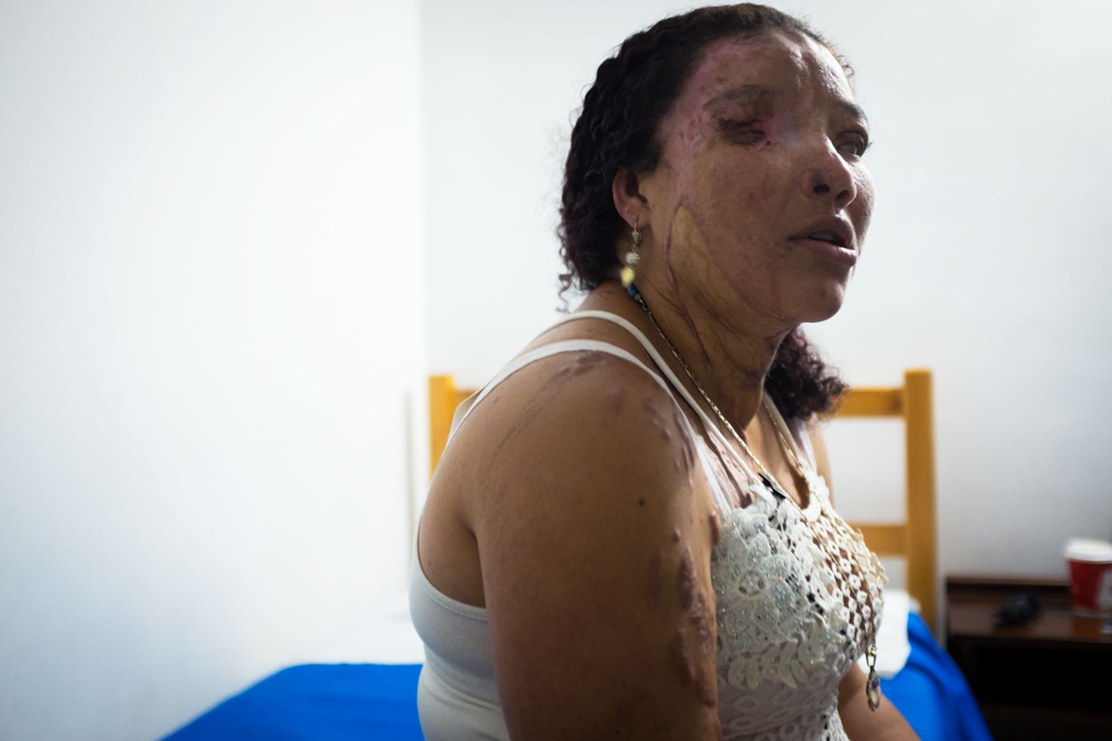 © Betty Laura Zapata - Image from the Facing Up: Acid Attacks in Colombia  photography project