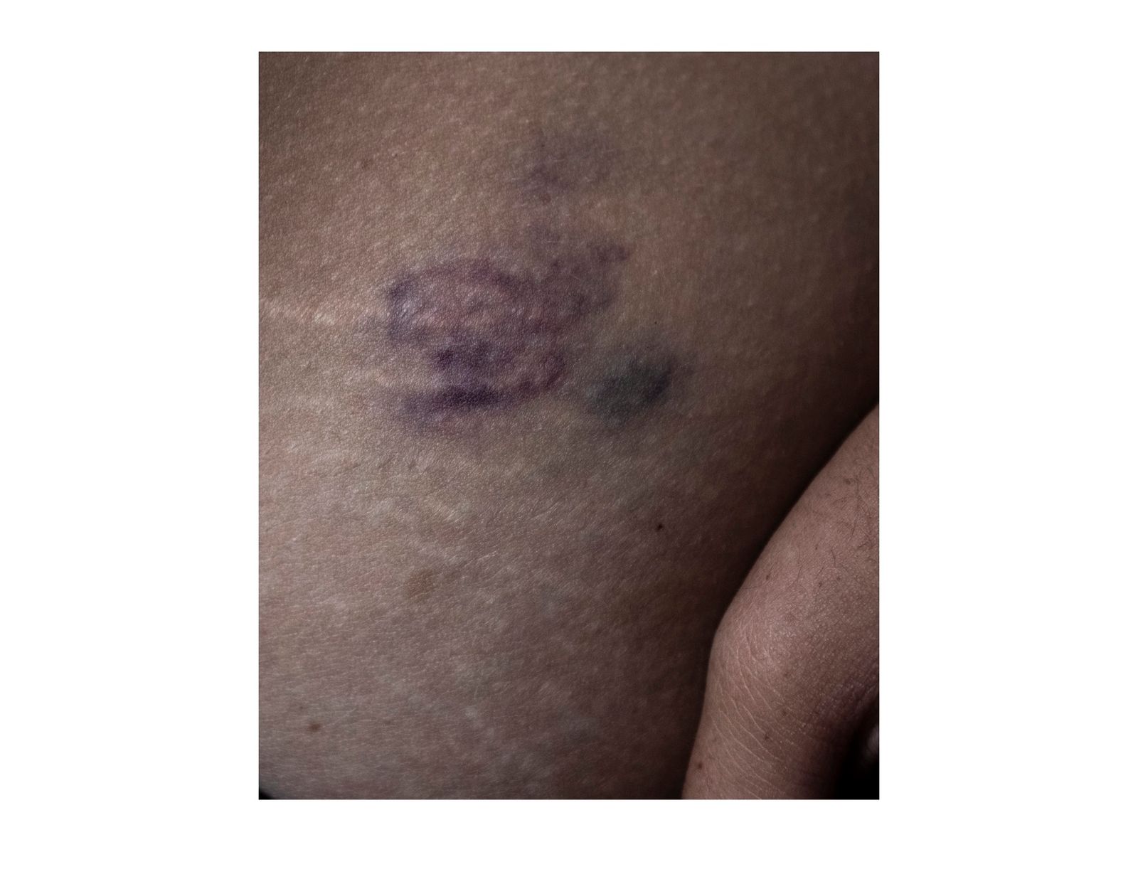 © Andrea Hernández Briceño - A bruise on Andrea Monsalve's belly in Caracas, Venezuela, on August 24, 2018
