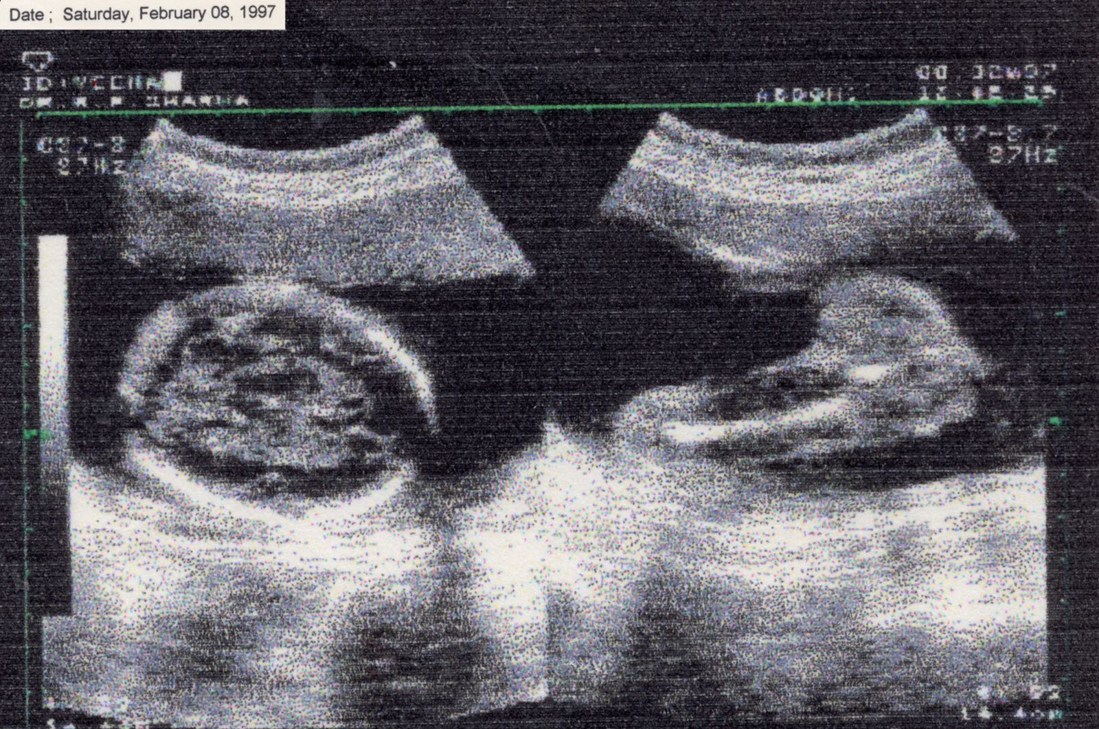 © Phalanvita Madhyala - I stare at it hoping to find myself. (From archive: prenatal CT scan of my mother’s pregnancy with my twin sister and me)