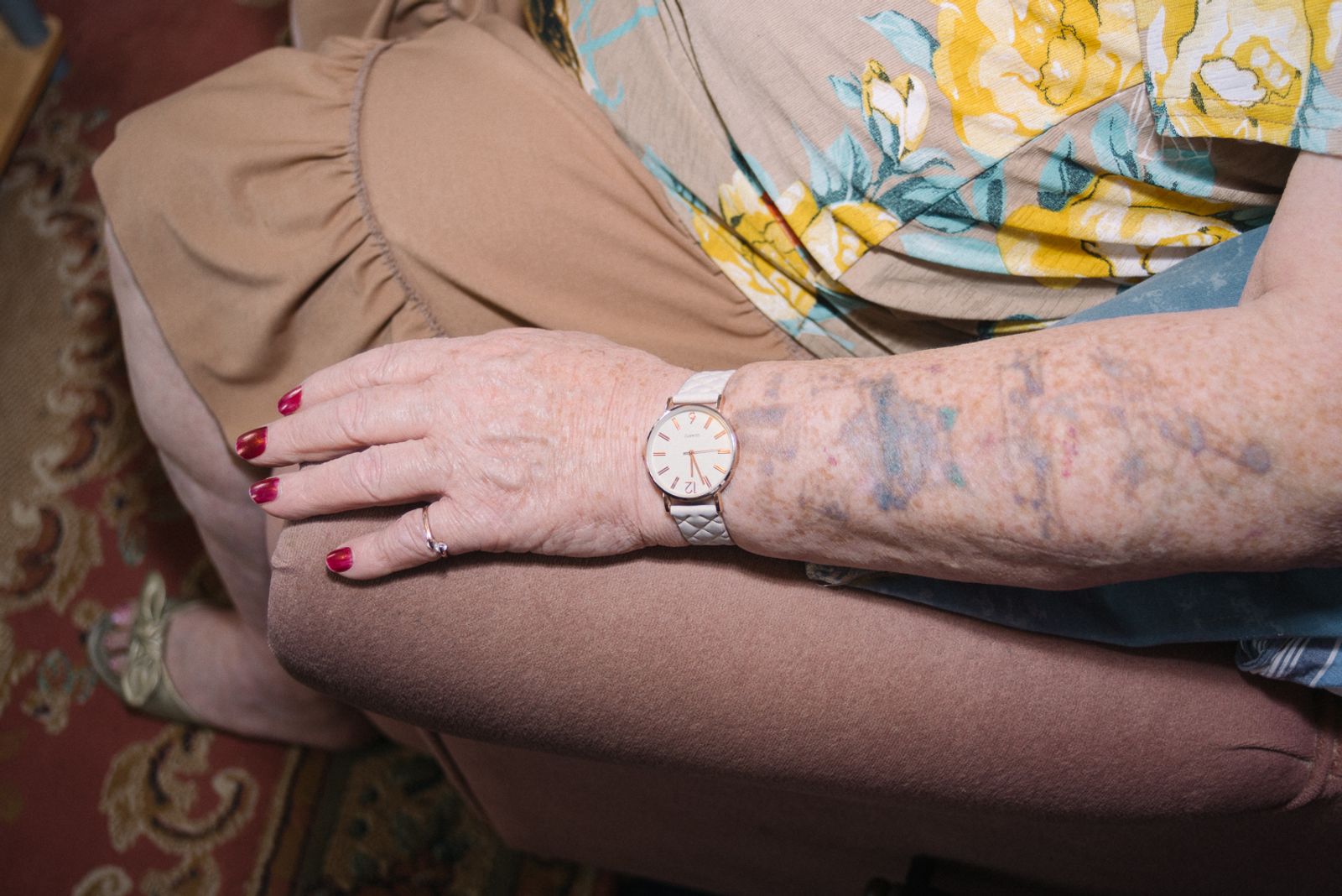 © Emma Wilson - Janet’s arm bearing the scars left by Jim’s military tattoos