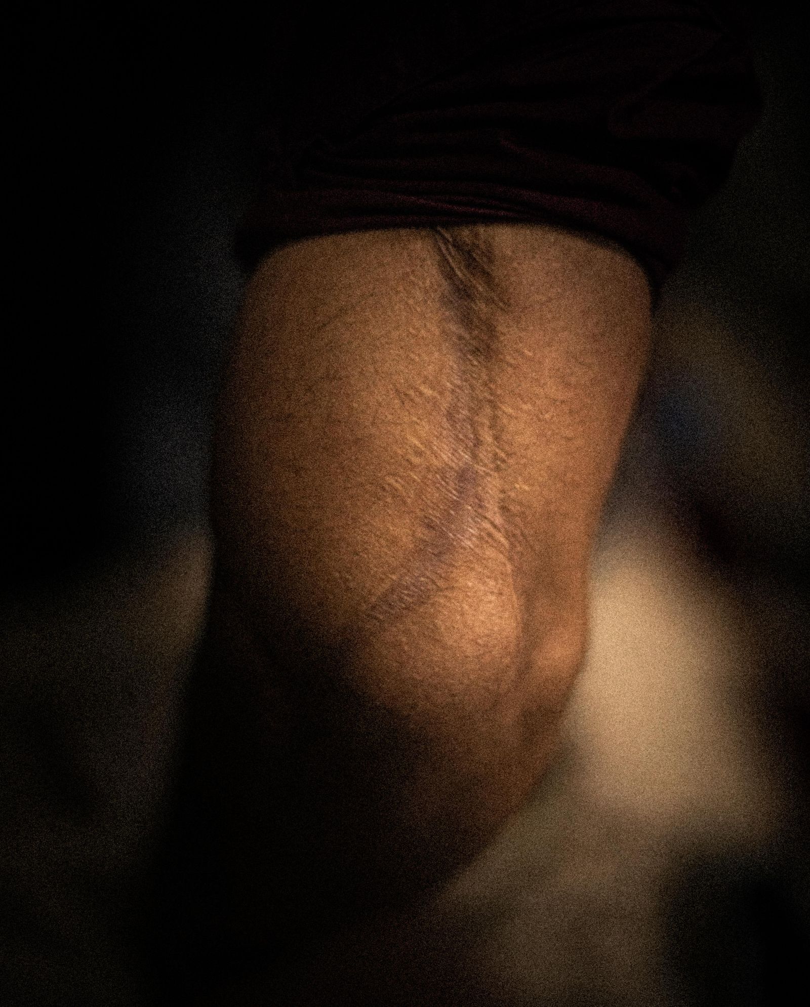 © Chloe Sharrock - Wound of a militiaman from the 2016 conflict against the Islamic State. Bassorah, Iraq.