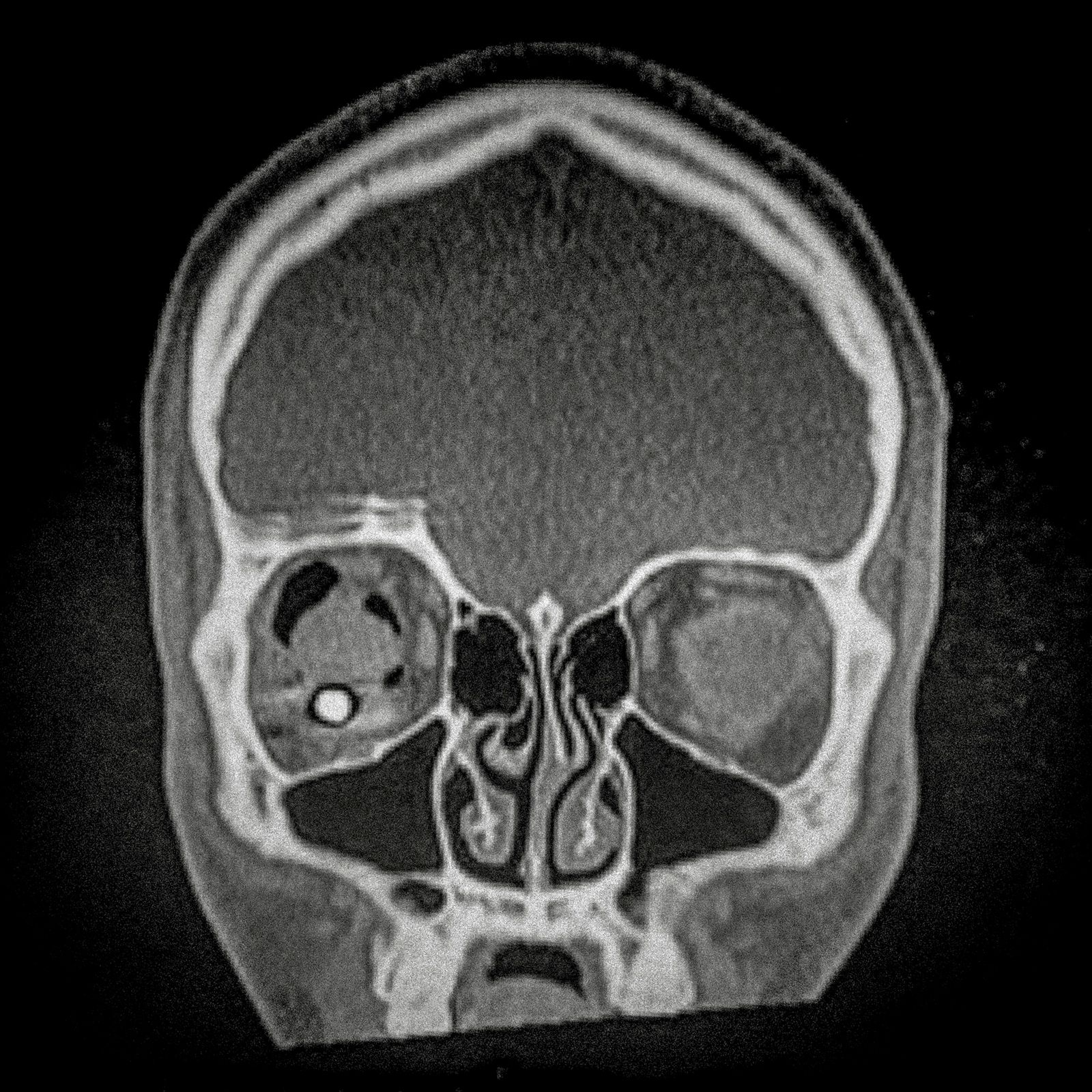 © Cristóbal Olivares - X ray showing the embedded pellet of an injured man during Santiago protests.