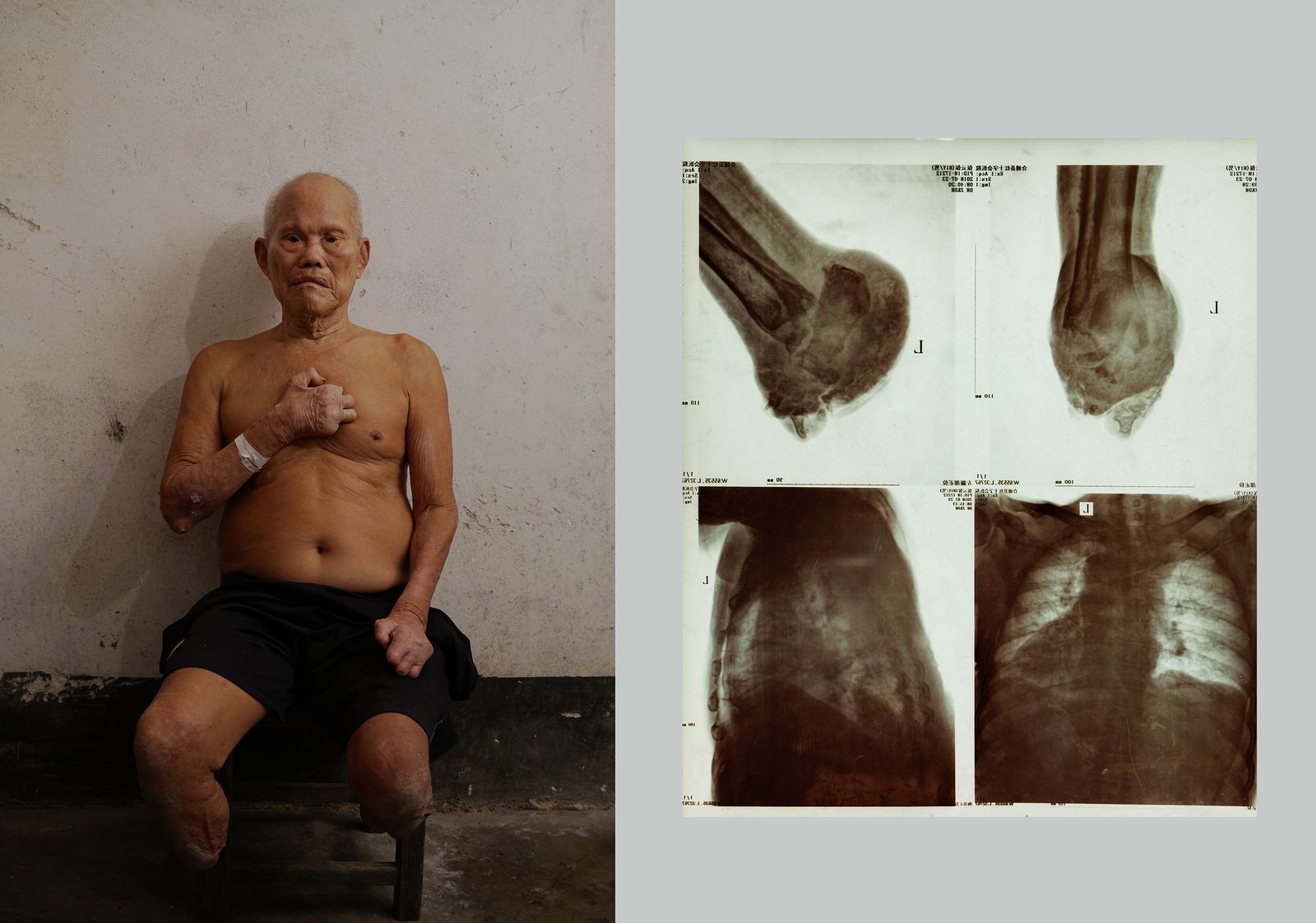 © Jin TIAN - A leprosy patient and his incomplete body.