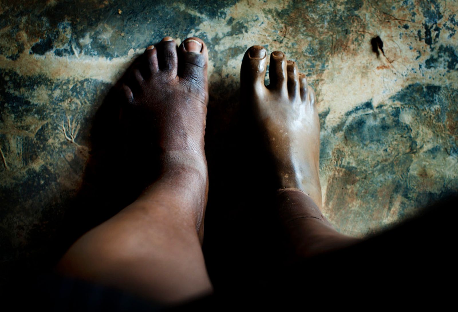 © Anne Ackermann - Irenes feet. She survived a landmine 12 years ago.