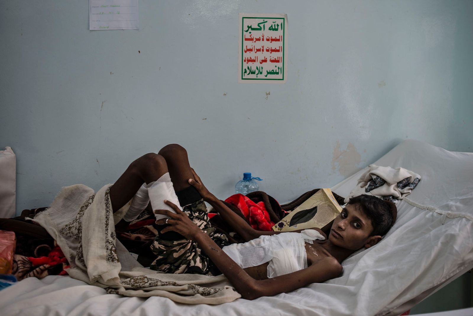 © Alex Potter - A Yemeni boy recovers in the hospital in Hajjah after he was injured in an airstrike that hit a wedding.