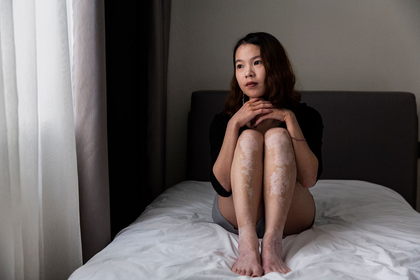 Woman with vitiligo holding pillow between legs on bed in front of white  wall at home