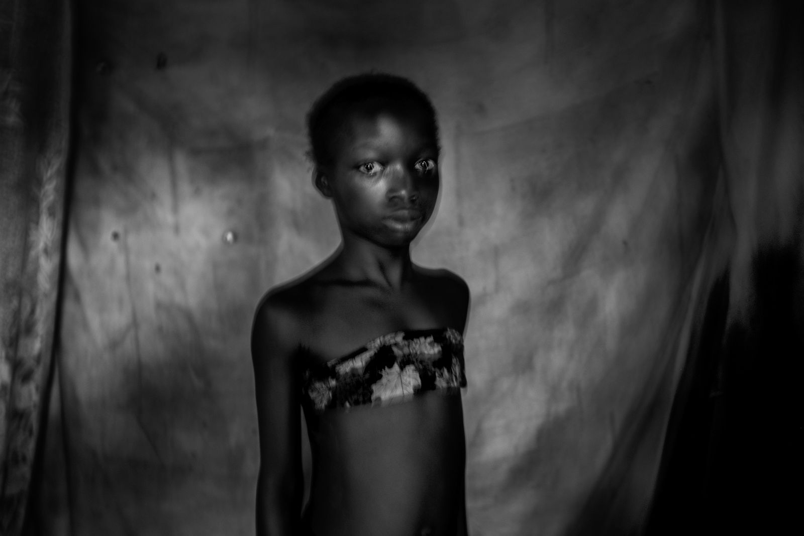 © Heba Khamis - Suzanne, 11 years old, experienced breast ironing couple of months before that image until her breast totally gone.