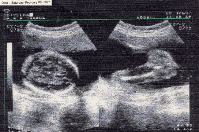 © Phalanvita Madhyala - I stare at it hoping to find myself. (From archive: prenatal CT scan of my mother’s pregnancy with my twin sister and me)